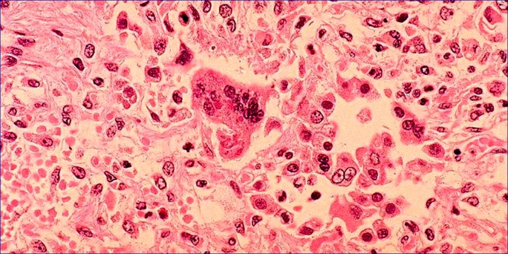 Health Officials in Pa. Alert Community to Measles Risk in Lebanon County
